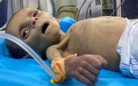 استشهاد طفلة نتيجة سوء التغذية في غزة