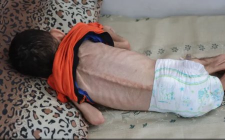 4 وفيات نتيجة المجاعة وسوء التغذية خلال الـ24 ساعة الماضية في قطاع غزة