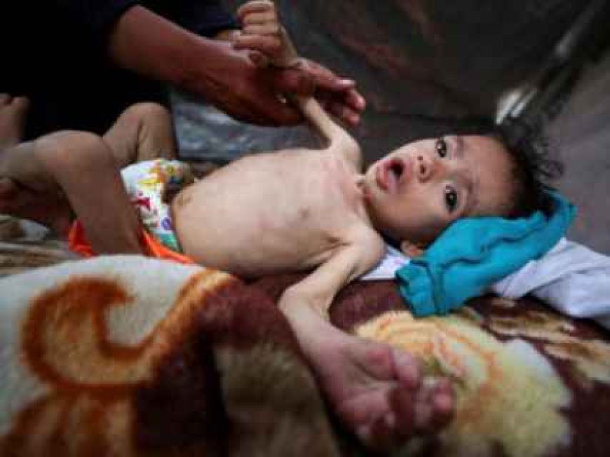 متلازمة “غيلان باريه”.. مرض جديد نادر يفتك بأطفال قطاع غزة بسبب الحرب والحصار والتجويع والصحة تحذر من انتشاره