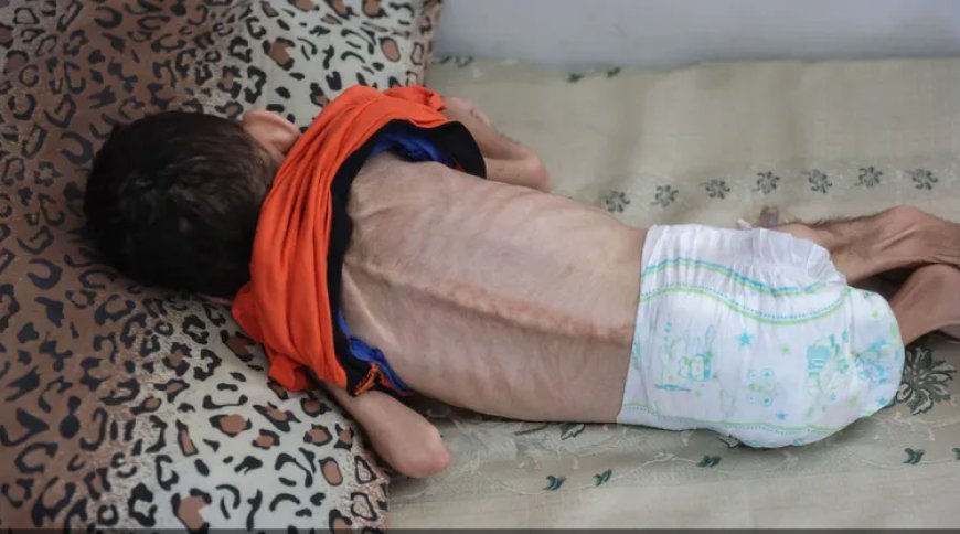 4 وفيات نتيجة المجاعة وسوء التغذية خلال الـ24 ساعة الماضية في قطاع غزة