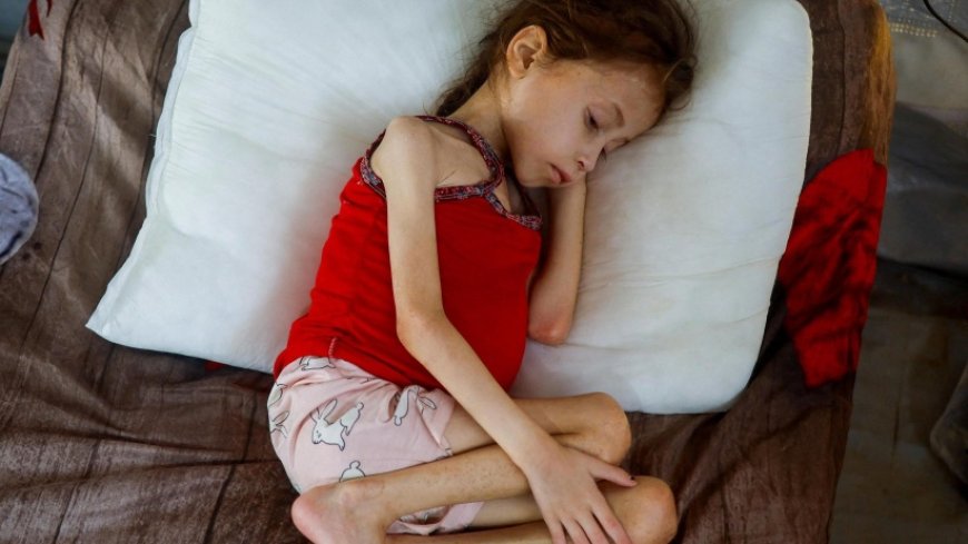 الاحتلال يتعمد تجويع أكثر من 100 ألف طفل ومريض بغزة