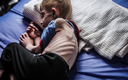 9 حالات وفاة نتيجة المجاعة وسوء التغذية خلال 24 ساعة