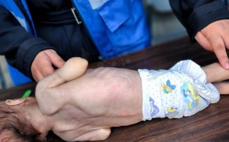 وفاة رضيع نتيجة سوء التغذية بغزة