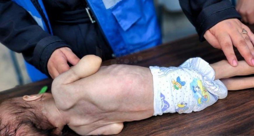 وفاة رضيع نتيجة سوء التغذية بغزة