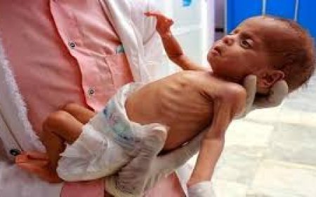 وفاة طفلين نتيجة التجويع وسوء التغذية في غزة